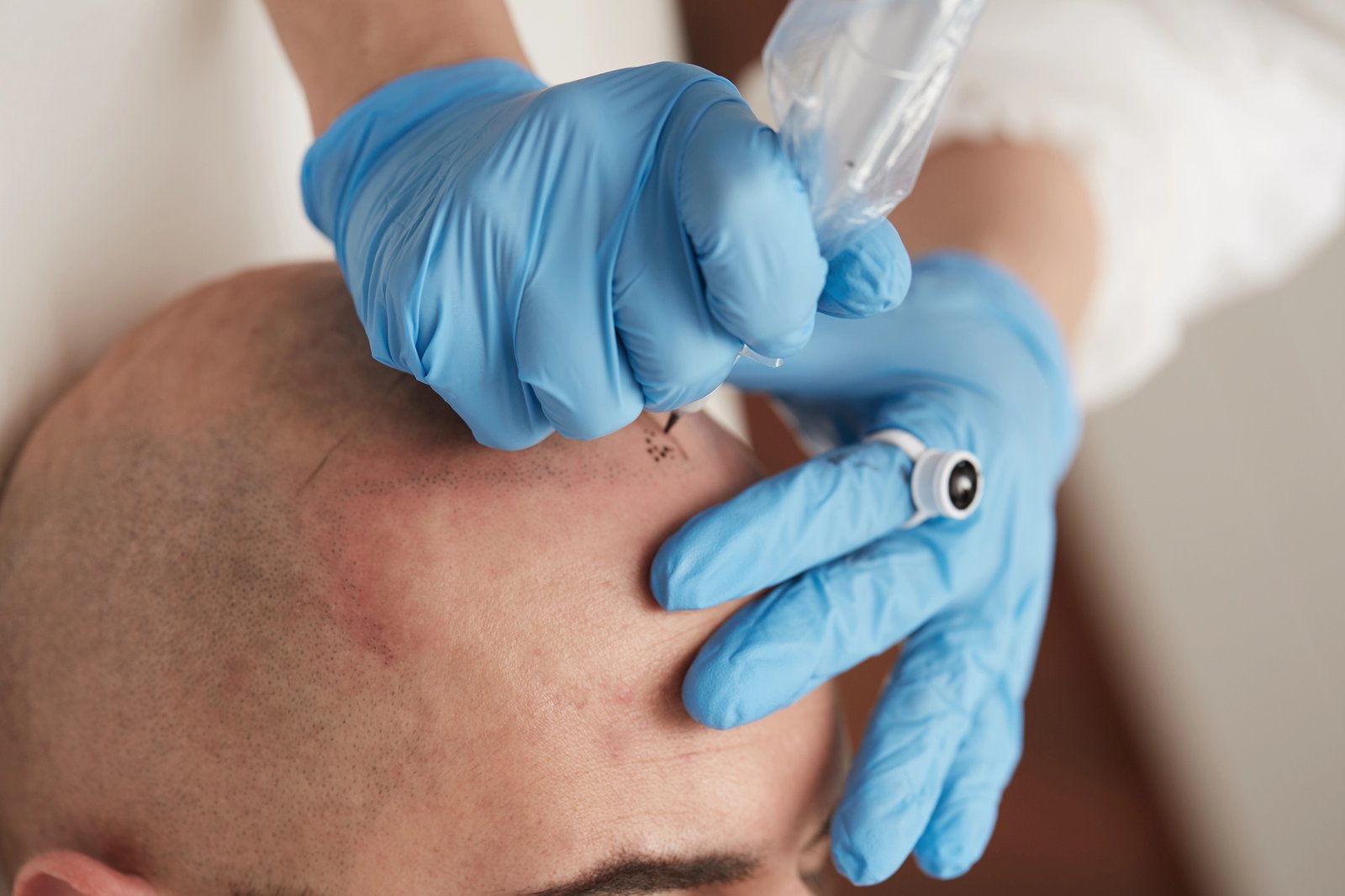 Scalp micropigmentation treatment procedure.